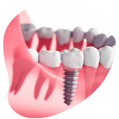 Grove city dentist - dental implants